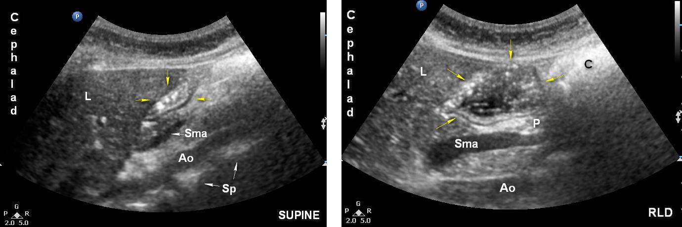 Legend: Ao: aorta A: antrum; C: colon; L: liver; P: pancreas; Sma: superior mesenteric artery; Yellow arrows: antrum.