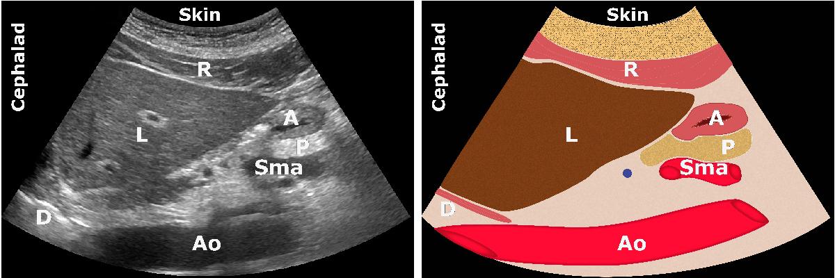 A: antrum; Ao: aorta; D: diaphragm;  L: liver; P: pancreas; R: rectus abdominis muscle; Sma: superior mesenteric artery