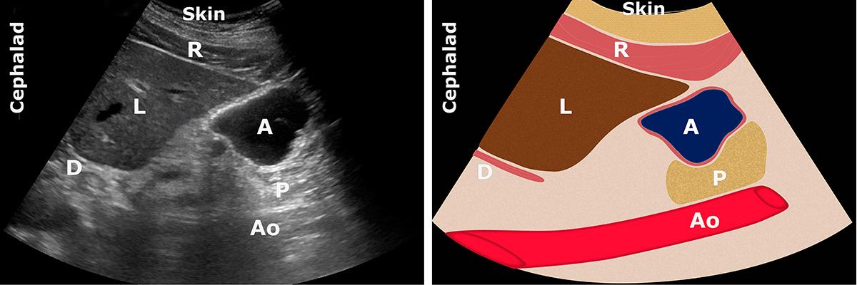 A: antrum; Ao: aorta; D: diaphragm; L: liver; P: pancreas; R: rectus abdominis muscle; S: spine; Sma: superior mesenteric artery