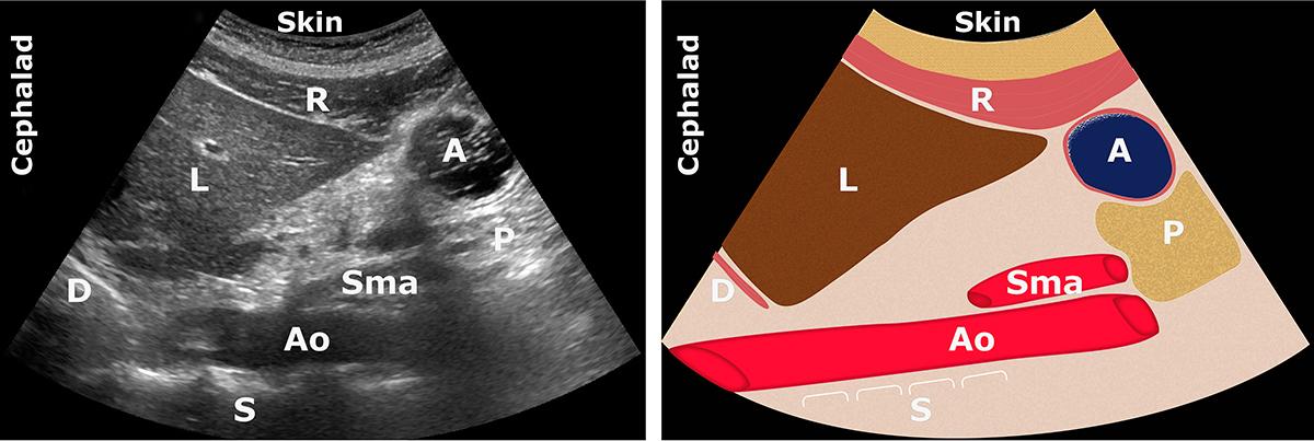 A: antrum; Ao: aorta; L: liver; P: pancreas; R: rectus abdominis muscle; S: spine; Sma: superior mesenteric artery