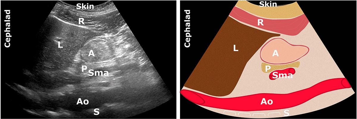 A: antrum; Ao: aorta; L: liver;  P: pancreas; R: Rectus Abdominis muscle; S: spine; Sma: superior mesenteric artery