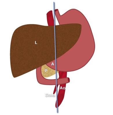 Blue line: scanning plane; A: antrum; Ao: aorta; L: liver; P: pancreas; Sma: superior mesenteric artery